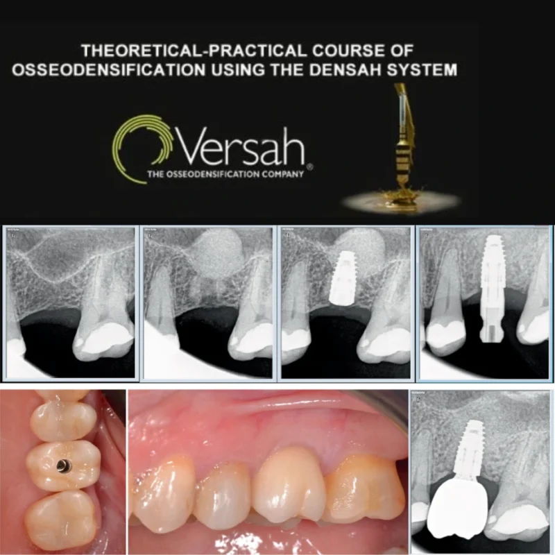 Osseodensification using the DENSAH System THEORETICAL-PRACTICAL COURSE